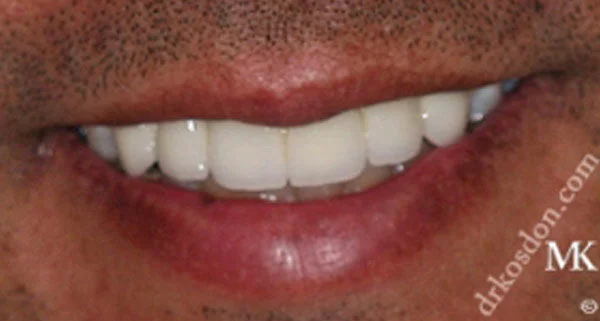 Porcelain Veneers