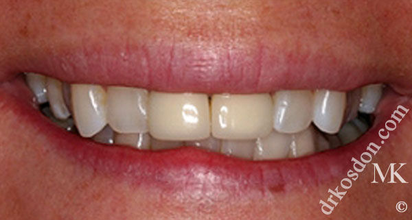 porcelain veneers before