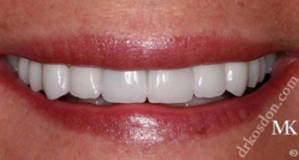 Porcelain Veneers