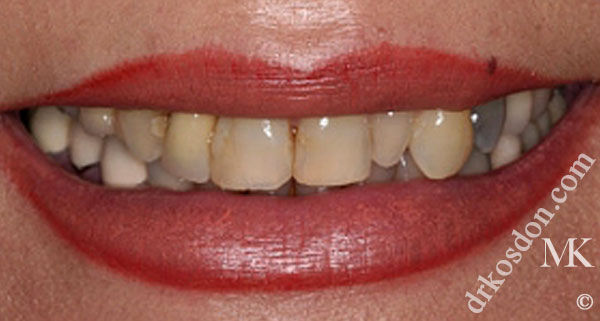 porcelain veneers before