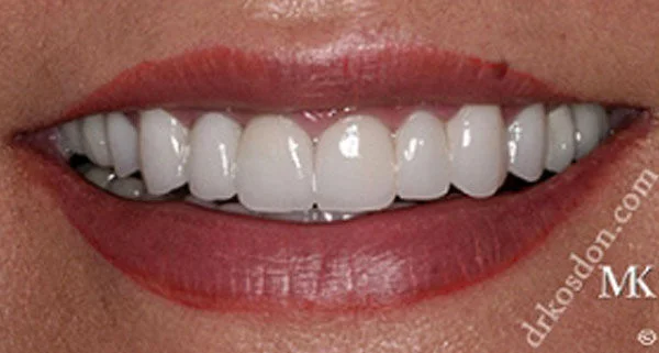 Porcelain Veneers