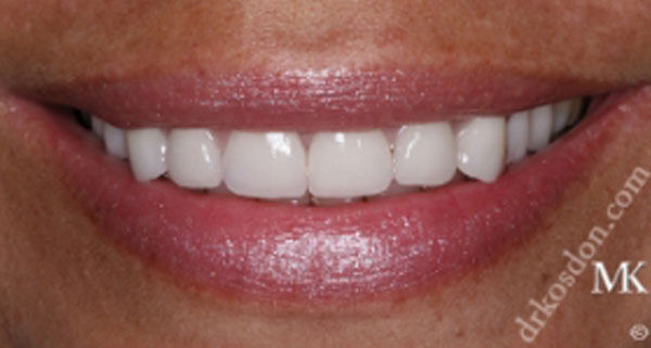 porcelain veneers after