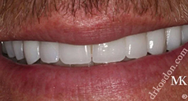 porcelain veneers after