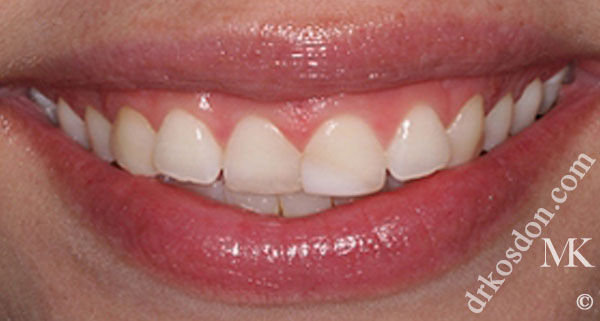 porcelain veneers before