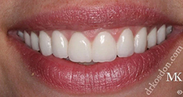 porcelain veneers after