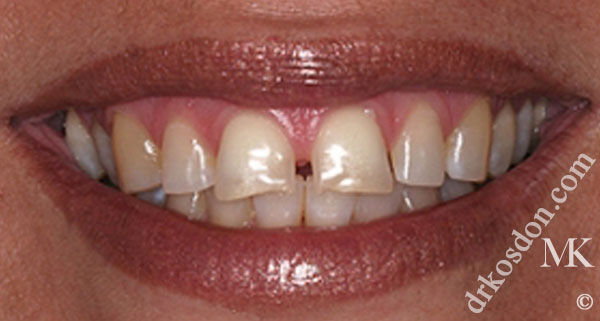 porcelain veneers before