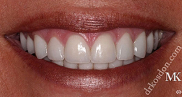 Porcelain Veneers