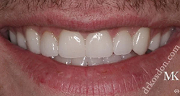 Porcelain Veneers