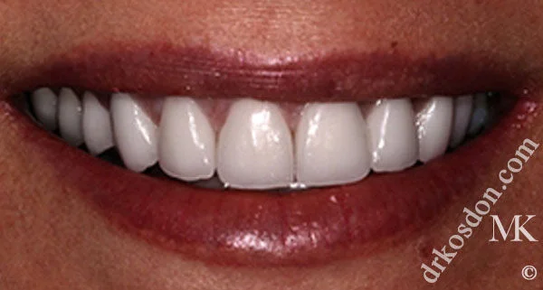 Porcelain Veneers