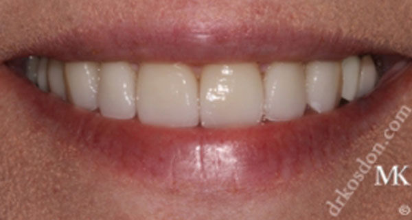 Porcelain Veneers