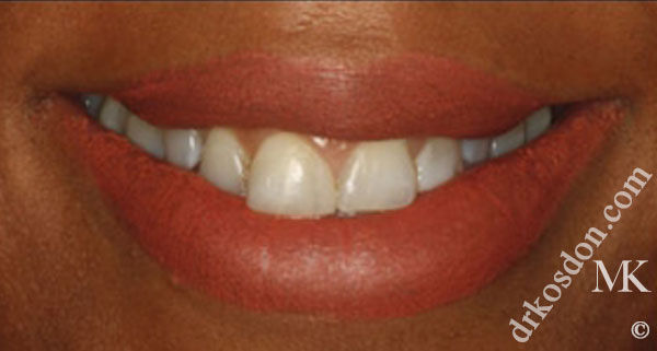 porcelain veneers before