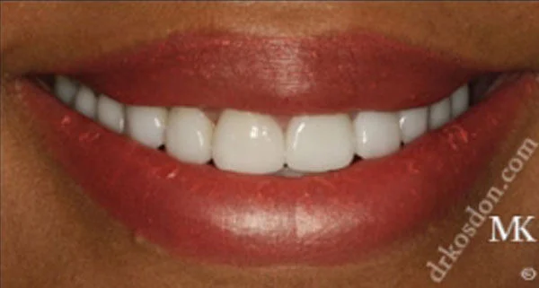 Porcelain Veneers