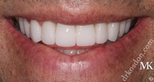 porcelain veneers after