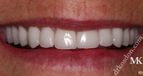 Porcelain Veneers