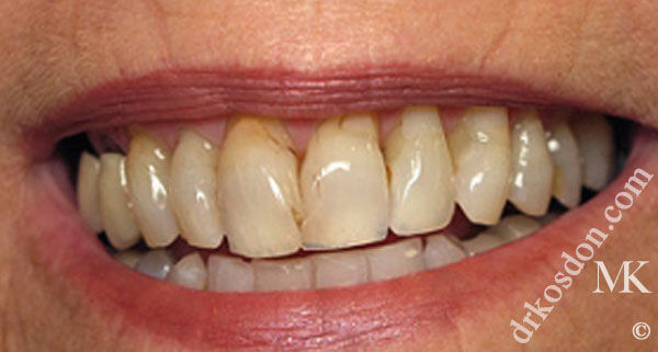 porcelain veneers before