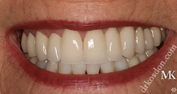 porcelain veneers after