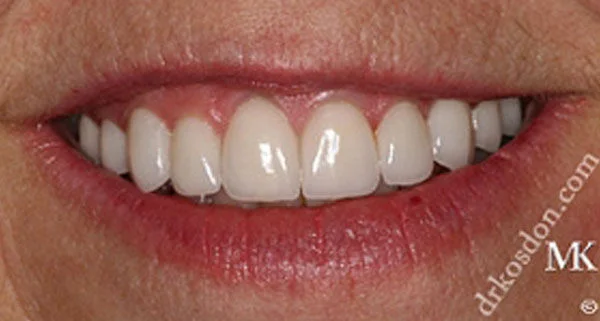 porcelain veneers after