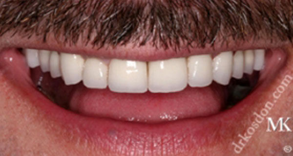 Porcelain Veneers