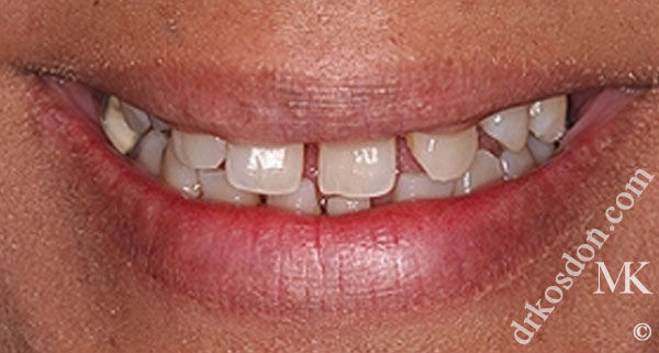 porcelain veneers before