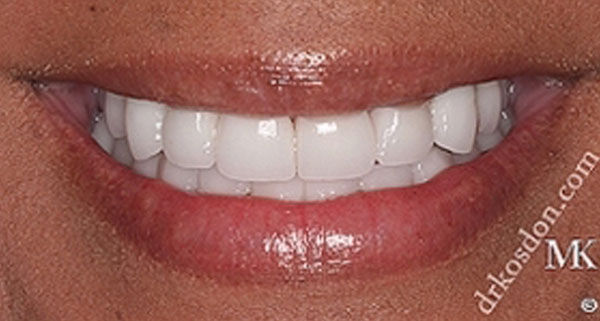 porcelain veneers after