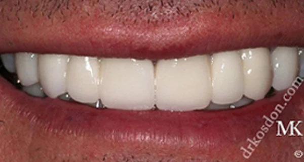 Porcelain Veneers