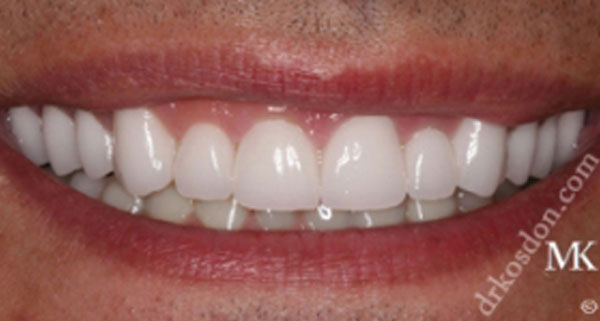 Porcelain Veneers