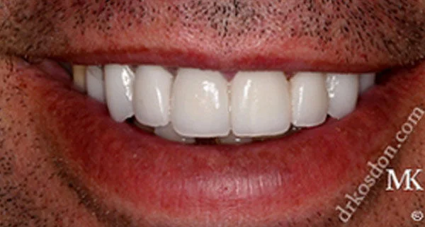 Porcelain Veneers