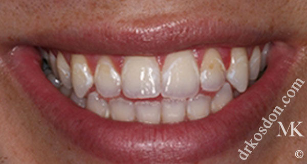 porcelain veneers before