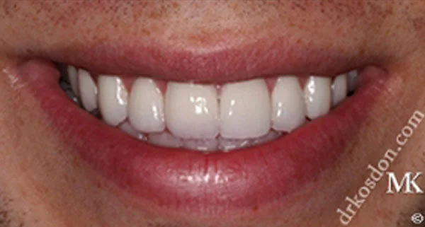 Porcelain Veneers