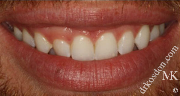 porcelain veneers before