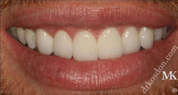 porcelain veneers after