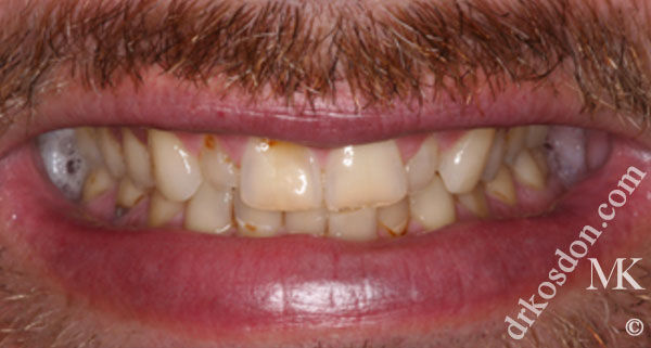 porcelain veneers before