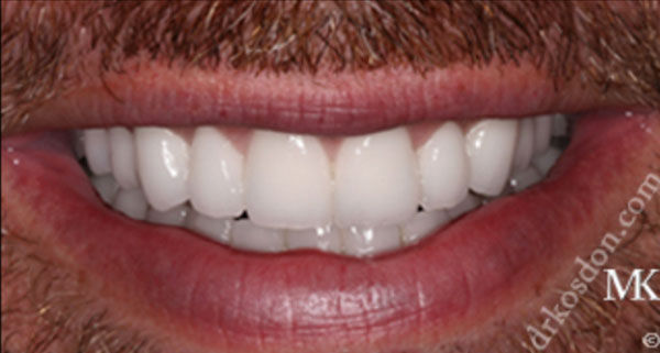 Porcelain Veneers