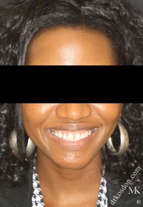 Porcelain Veneers Before