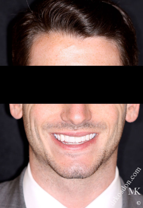 porcelain veneers after