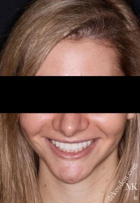 Porcelain Veneers After