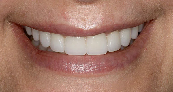 porcelain veneers after