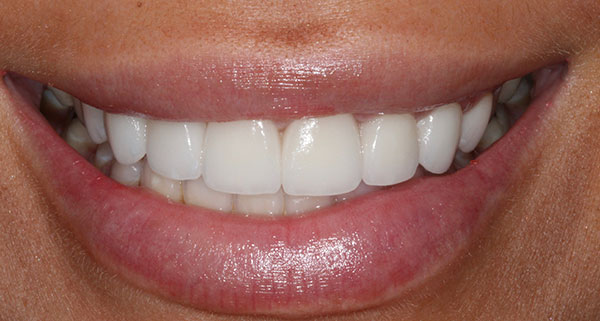 Porcelain Veneers