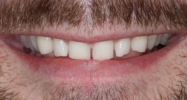 porcelain veneers before