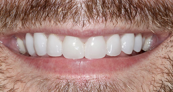 porcelain veneers after