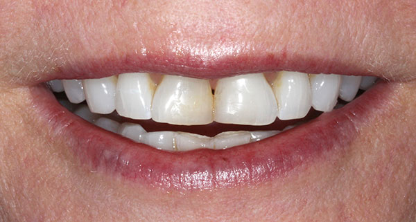 porcelain veneers before