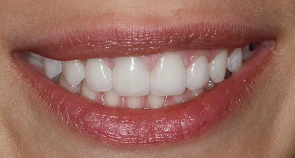 Porcelain Veneers