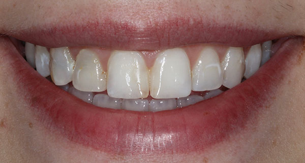 porcelain veneers before