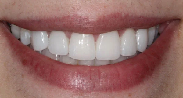 Porcelain Veneers