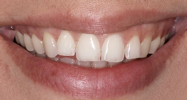 porcelain veneers before