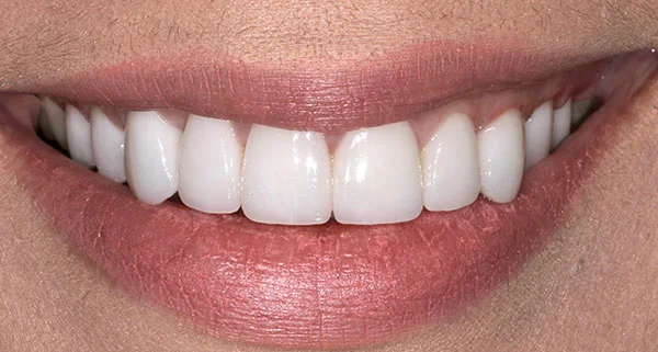 Porcelain Veneers