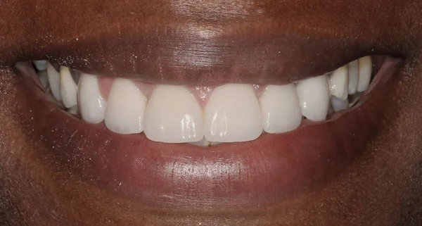 porcelain veneers after