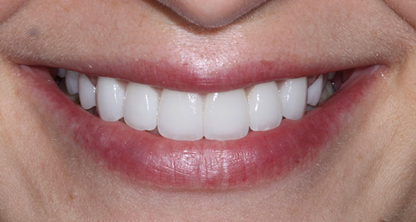 porcelain veneers after