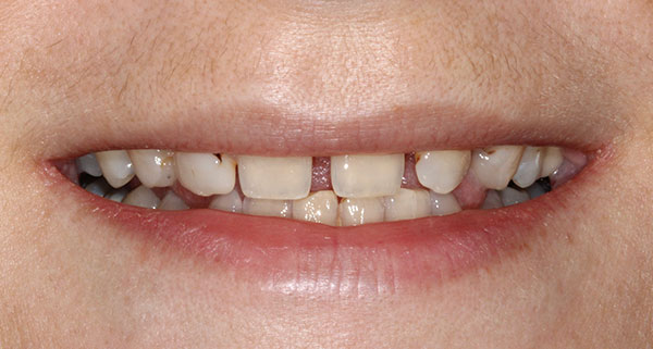 porcelain veneers before