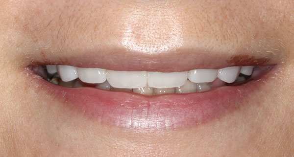 porcelain veneers after